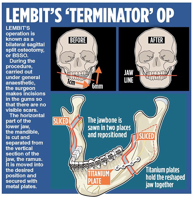 During his surgery Opik's jaw was repositioned and titanium plates were inserted to keep his bones in place